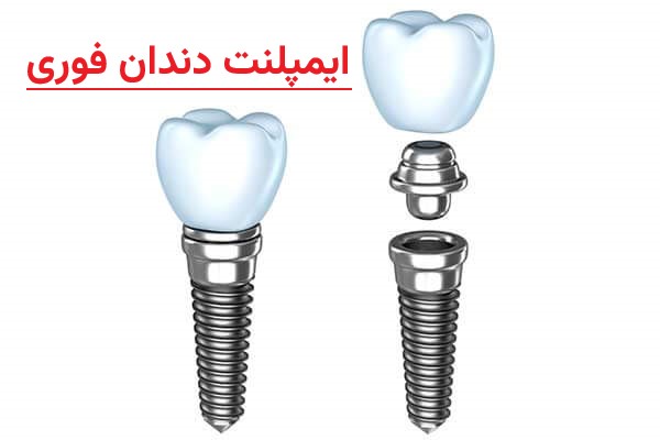 ایمپلنت دندان فوری