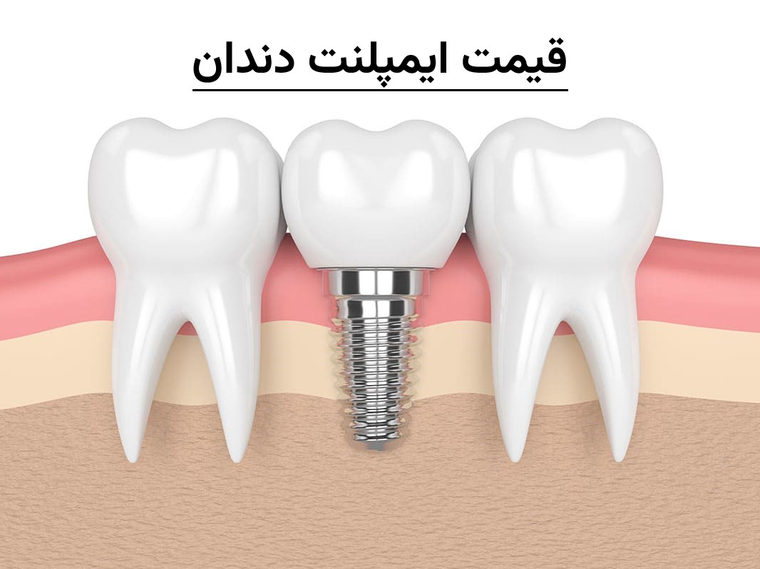 قیمت ایمپلنت دندان