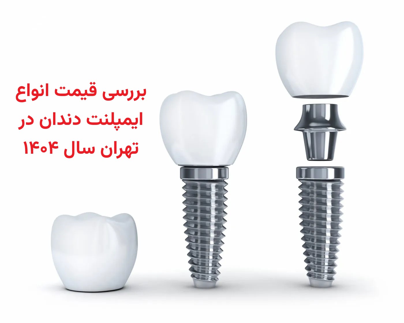 بررسی قیمت انواع ایمپلنت دندان در تهران سال 1404