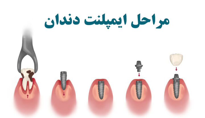 مراحل ایمپلنت دندان چیست (۶ مرحله ایمپلنت + فیلم وعکس) مراحل ایمپلنت دندان چیست (۶ مرحله ایمپلنت + فیلم وعکس)