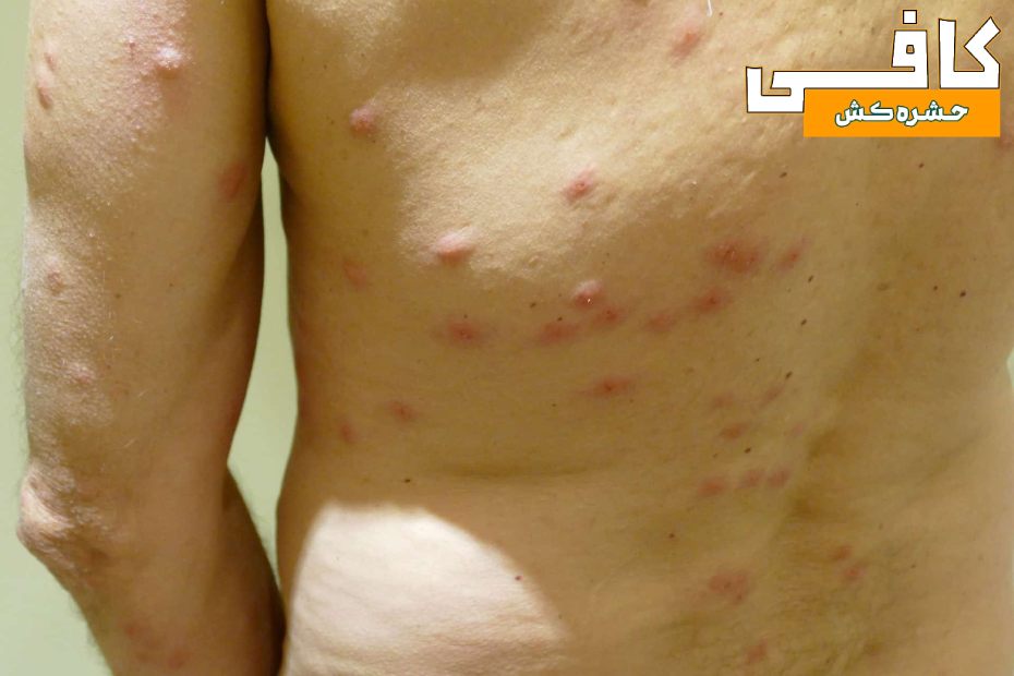 تعداد زیادی از نیش ساس بر پشت یک مرد