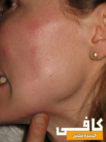 نیش‌های خفیف ساس روی صورت یک زن