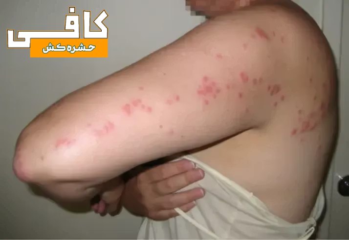 عکس نیش های پراکنده حشره ساس بر بدن انسان با الگوی زیگزاگ
