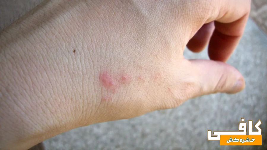 عکس جای نیش ساس بر روی دست