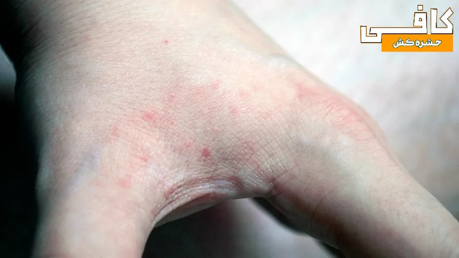 عکس جای نیش ساس در بین انگشتان