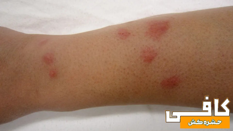 عکس جای نیش ساس در ساعد دست