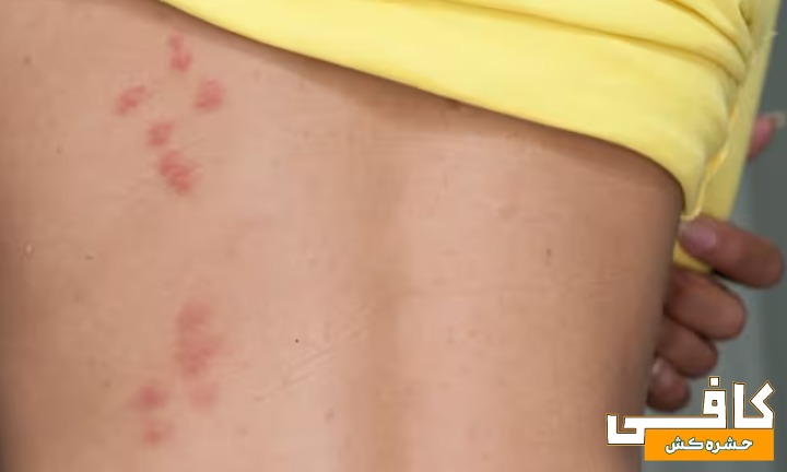 عکس جای نیش ساس در بدن