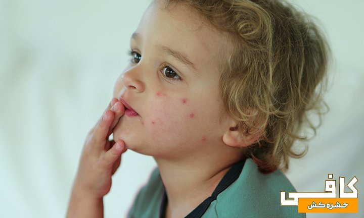 عکس جای نیش ساس در صورت بچه