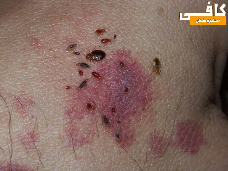 ساس های زنده بر روی پوست دست