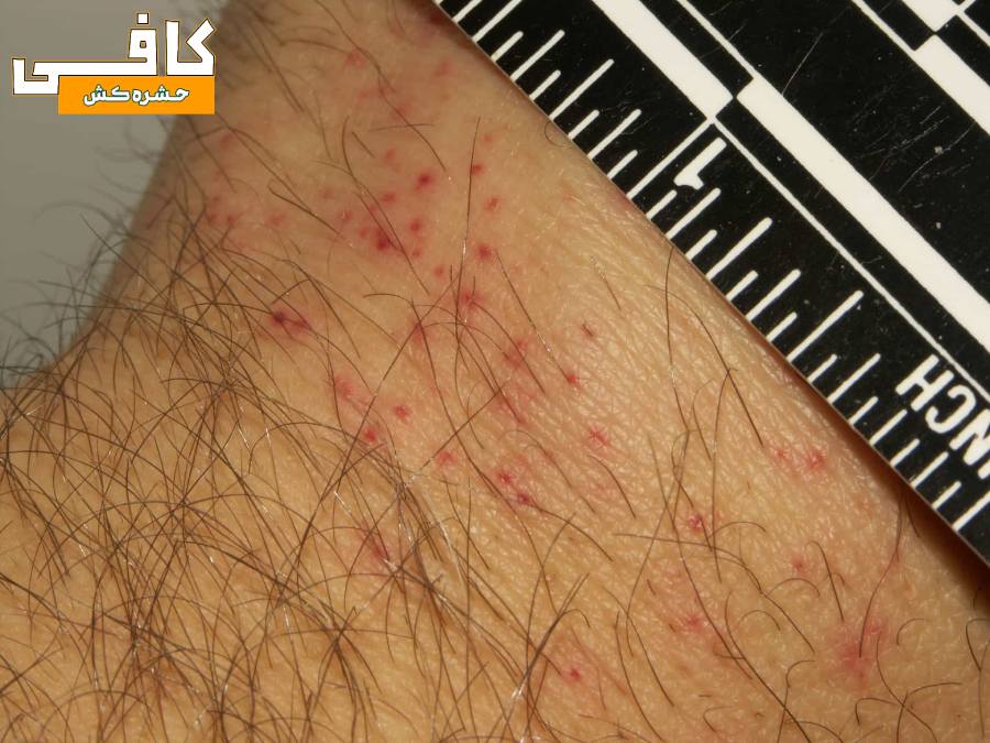 عکس جای نیش ساس بر پوست دست
