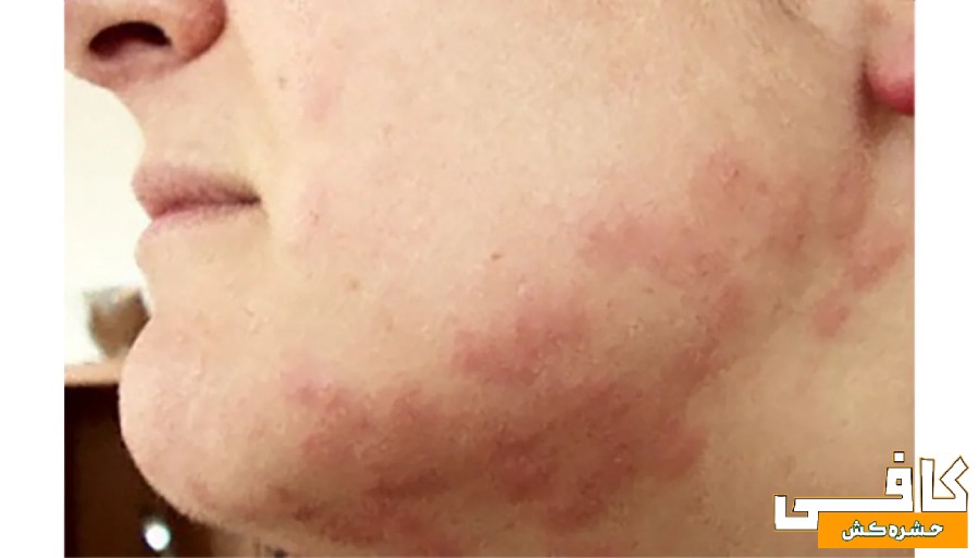 عکس جای نیش ساس روی صورت