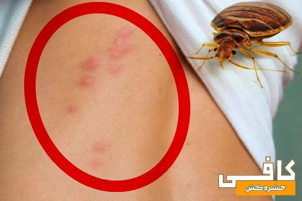 عکس جای نیش ساس [تصاویر واقعی از گزش ساس تختخوابی]