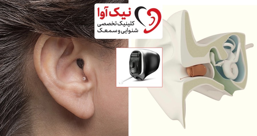 سمعک فوناک در کلینیک نیک آوا