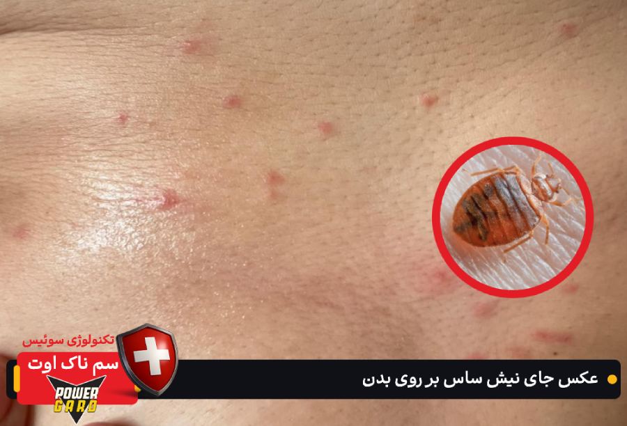 جای نیش ساس