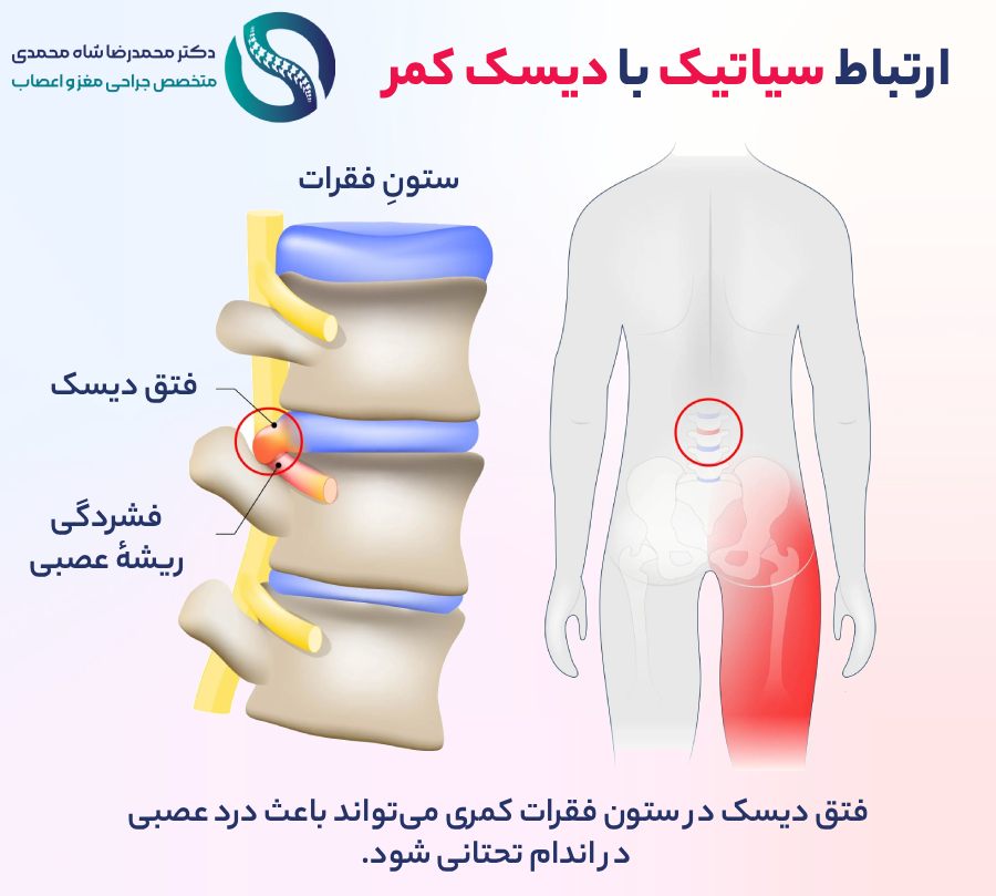 ارتباط سیاتیک با دیسک کمر - دکتر شاه محمدی جراح دیسک کمر در تهران