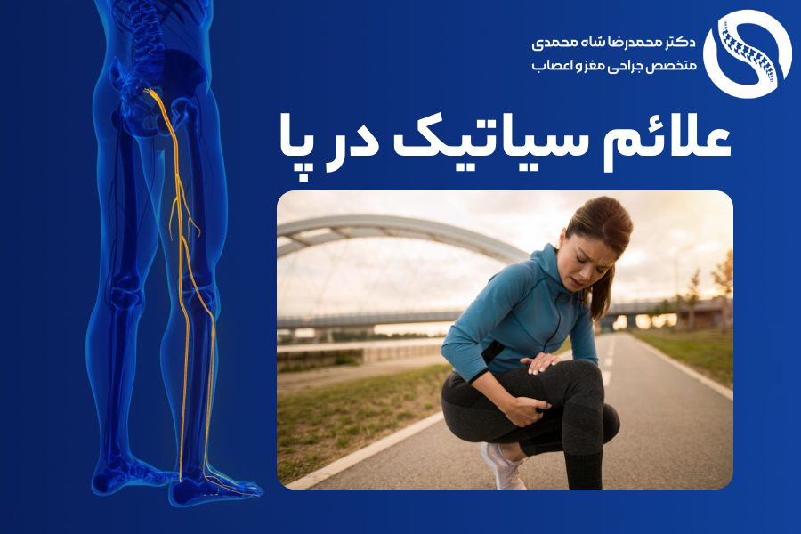 علائم سیاتیک در پای چپ یا راست - دکتر شاه محمدی جراح دیسک کمر تهران