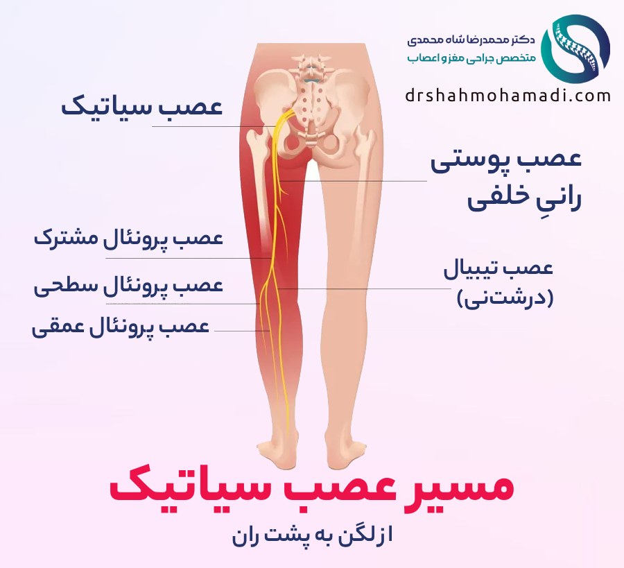 مسیر عصب سیاتیک در بدن - دکتر شاه محمدی متخصص دیسک کمر در تهران