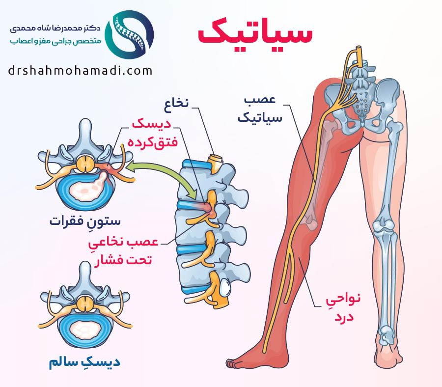 سیاتیک چیست؟ تصویر عصب سیاتیک - دکتر شاه محمدی متخصص دیسک کمر