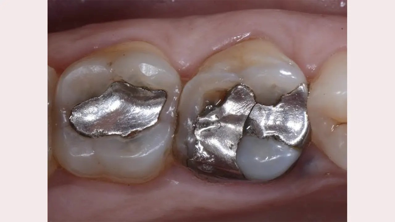 معرفی جدیدترین مواد ترمیمی دندان با استحکام فولاد + زیبایی الماس