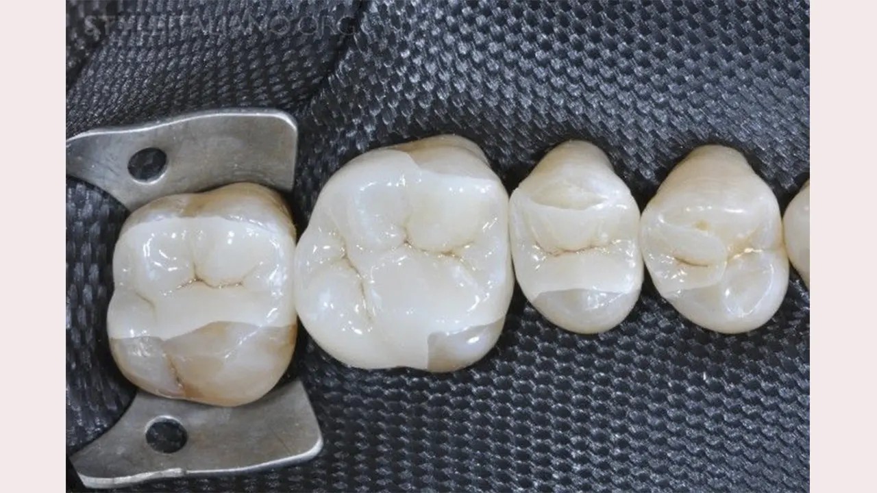 معرفی جدیدترین مواد ترمیمی دندان با استحکام فولاد + زیبایی الماس