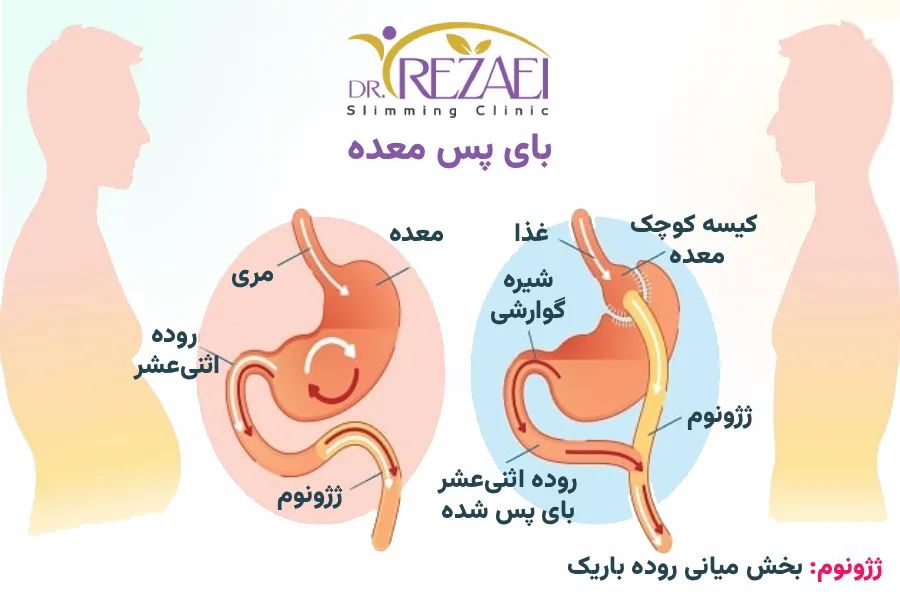 عمل بای پس معده - دکتر محمدتقی رضایی بهترین جراح چاقی در تهران