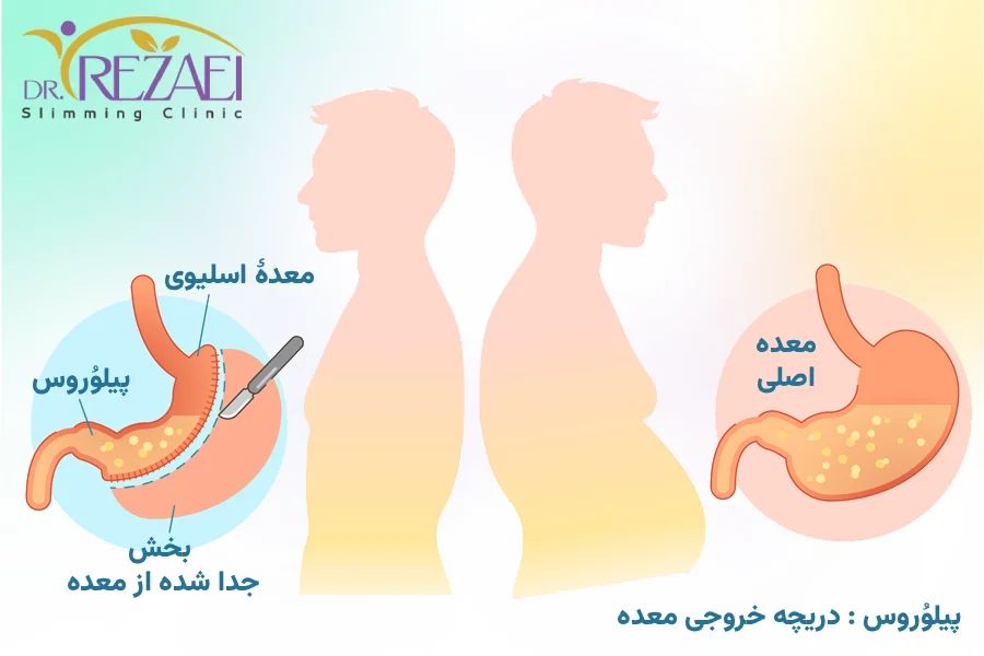 عمل جراحی اسلیو معده - دکتر محمدتقی رضایی بهتریج جراح چاقی در تهران