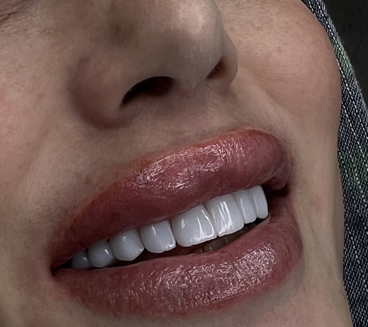 لبخند رضایت مشتری کامپوزیت دندان