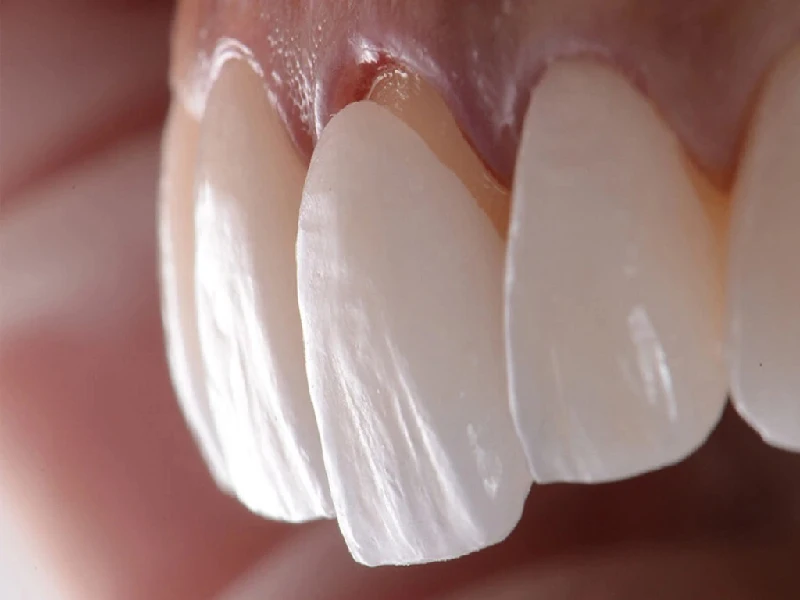 کامپوزیت دندان با بیمه