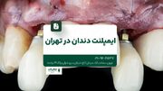 ایمپلنت دندان در تهران