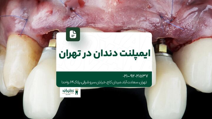 ایمپلنت دندان در تهران ایمپلنت دندان در تهران
