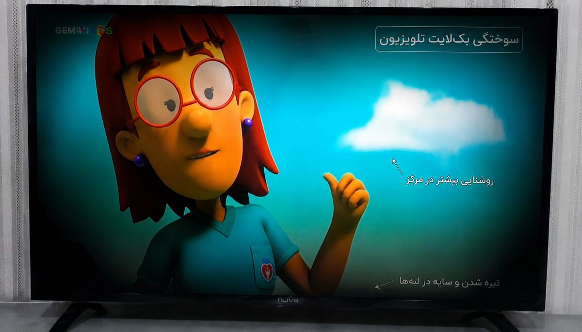 سوختگی بکلایت