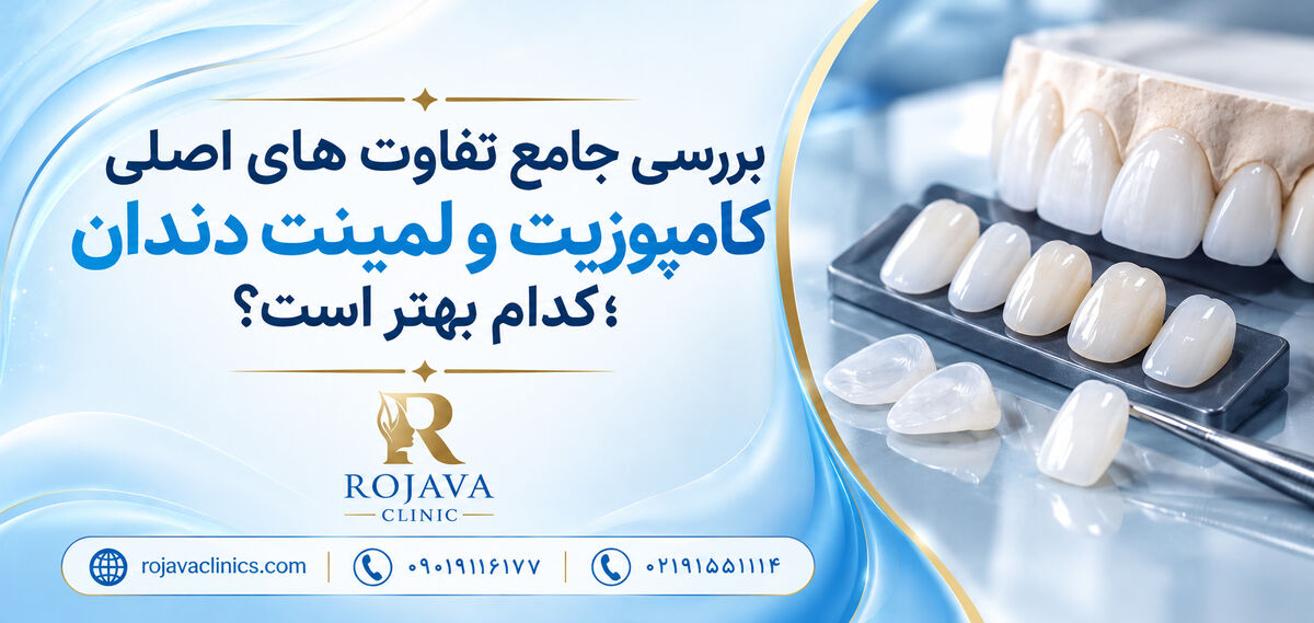 تفاوت لمینت و کامپوزیت دندان چیست؟ بررسی تفاوت ها، ماندگاری و هزینه ؛ کدام برایتان بهتر است؟